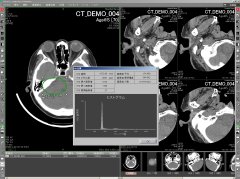 マルチモダリティ医療用画像ビューワ 計測機能